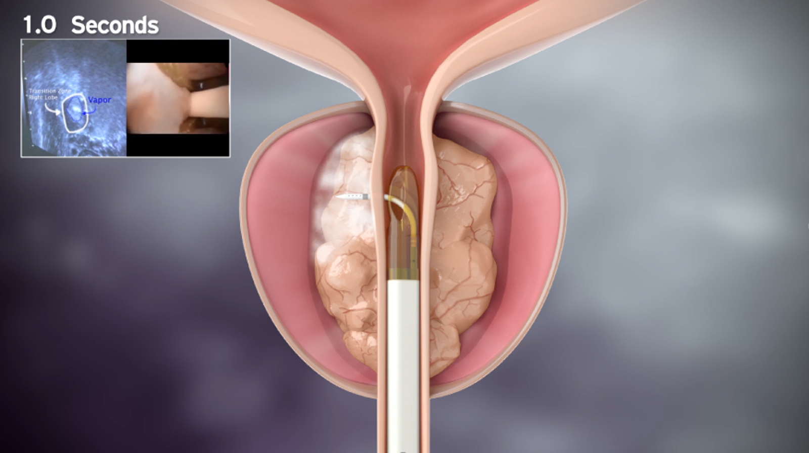 前立腺肥大症外来1